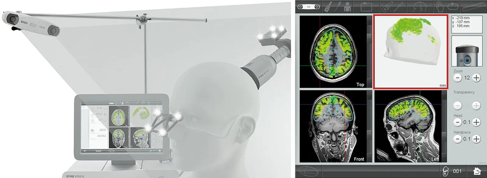 Die Kombination aus 3D-Kamera und MRT-Bilder ermöglicht eine präzise Stimulation.